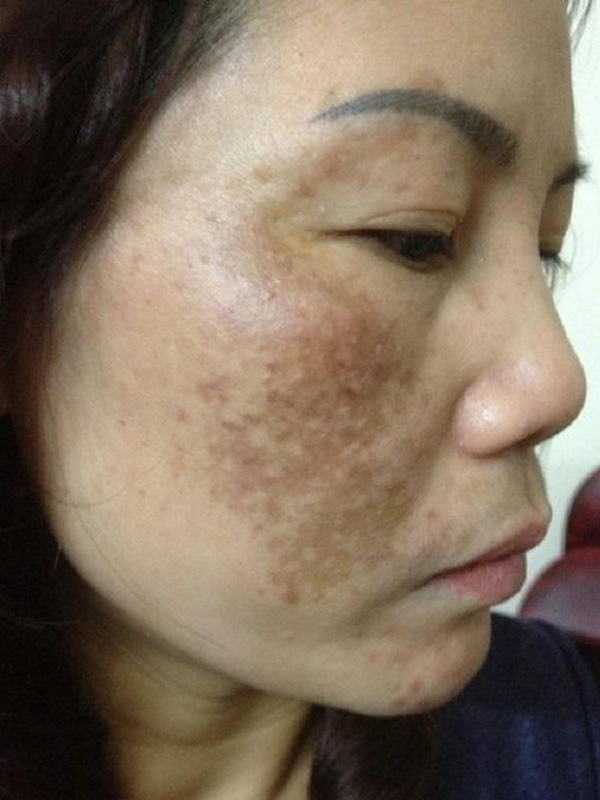 5 Diem Phan Biet Ro Ret Giua Da Bi Nam Va Tan Nhang 702 4